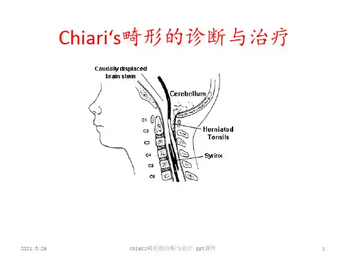 chiari畸形的诊断与治疗 ppt课件