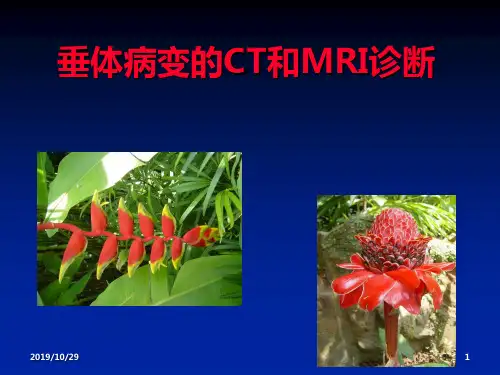 垂体病变的CT和MRI诊断PPT课件