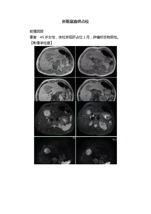 肝脏富血供占位
