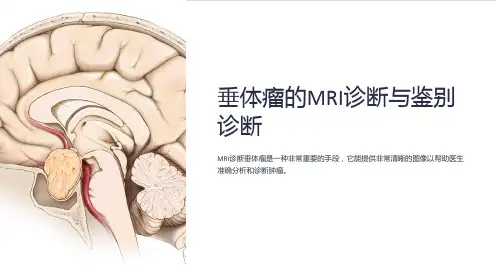 垂体瘤的MRI诊断与鉴别诊断课件