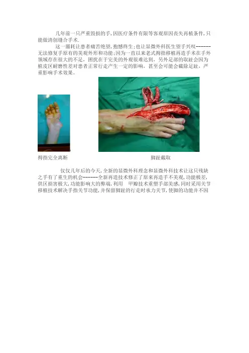 拇指缺损再造重庆长城医院成功案例