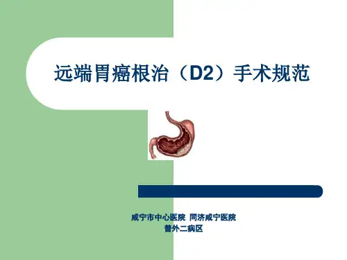 远端胃癌根治(D2)手术规范