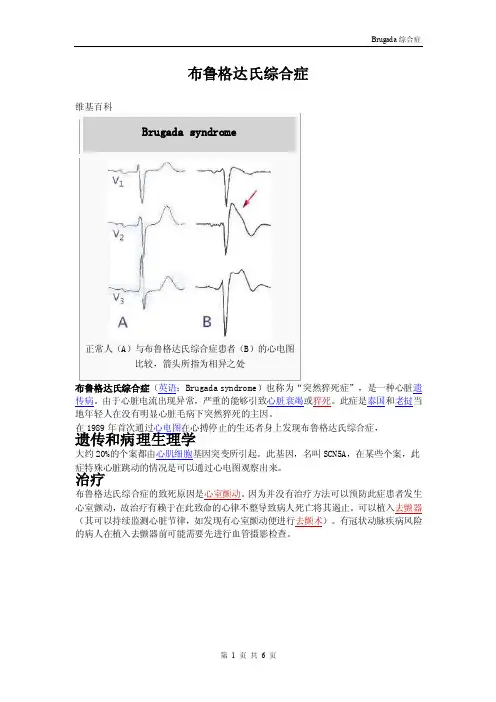 布鲁格达氏综合症