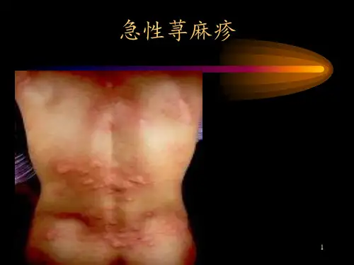 寻麻疹PPT课件