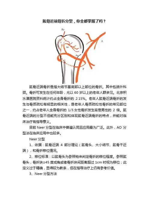 肱骨近端骨折分型，你全都掌握了吗？