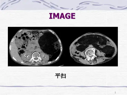 脂肪肉瘤的CT表现一例PPT课件