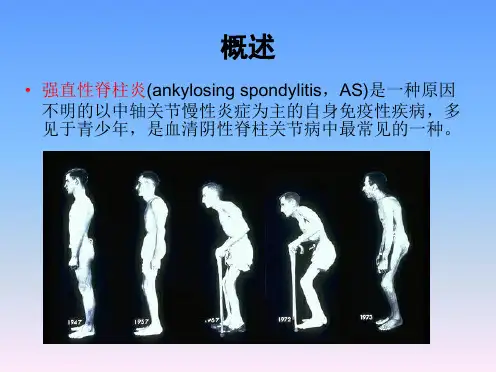 强直性脊柱炎MRI评分