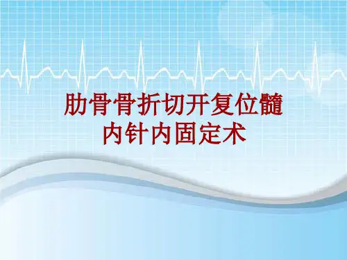 手术讲解模板：肋骨骨折切开复位髓内针内固定术