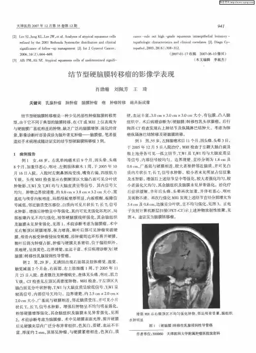 结节型硬脑膜转移瘤的影像学表现