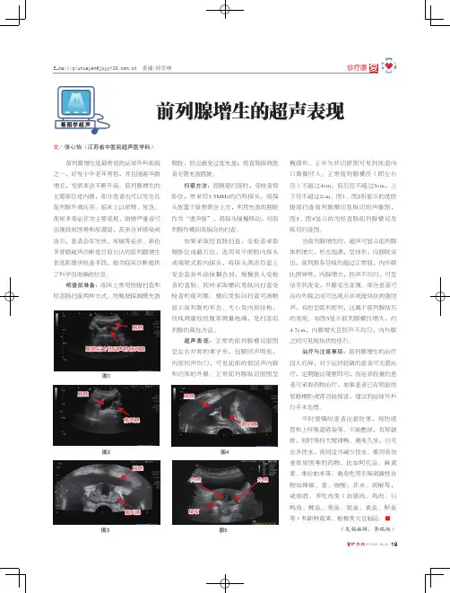 前列腺增生的超声表现