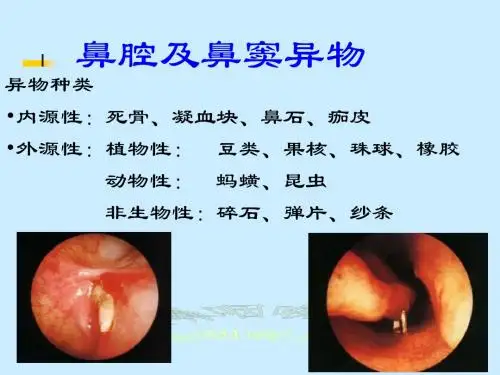2-nasal.foreign%20object[1]鼻腔及鼻窦异物