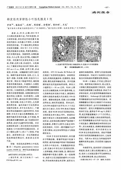 特发性肉芽肿性小叶性乳腺炎1例