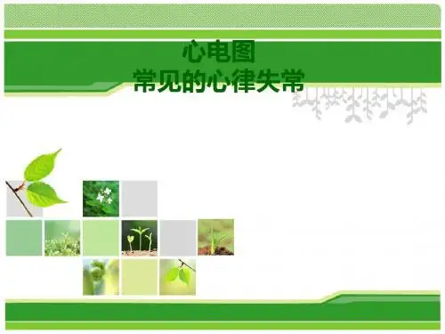 心电图 常见的心律失常