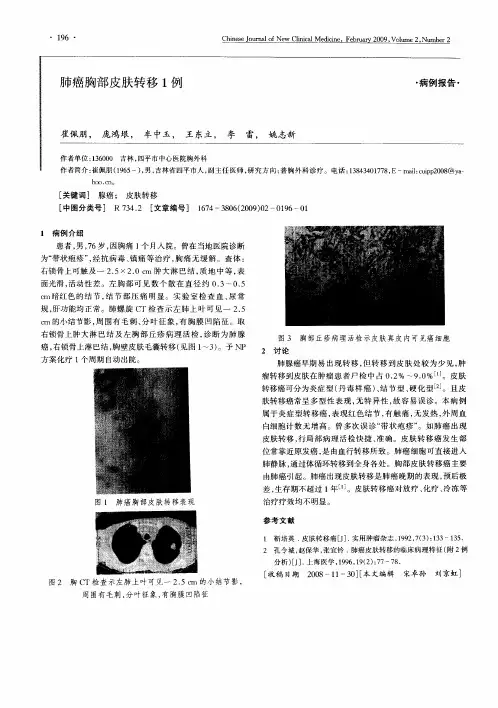 肺癌胸部皮肤转移1例