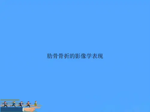 肋骨骨折的影像学表现PPT资料