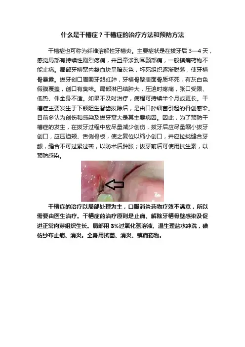 什么是干槽症？干槽症的治疗方法和预防方法