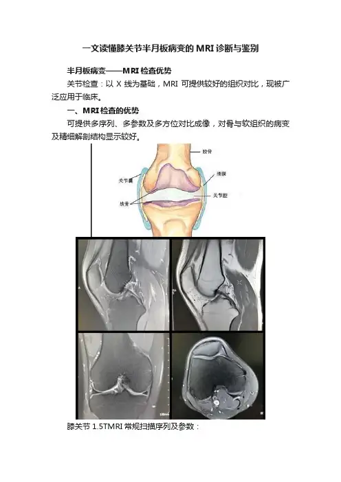 一文读懂膝关节半月板病变的MRI诊断与鉴别