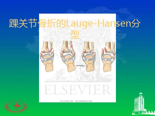 踝关节骨折的Lauge-Hansen分型