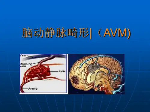 脑动静脉畸形影像诊断ppt课件