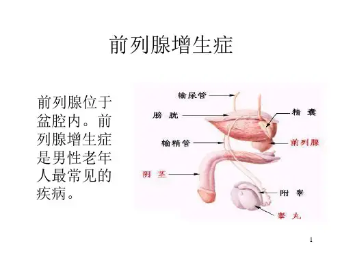 前列腺增生症PPT课件