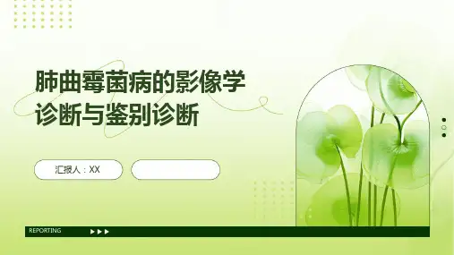肺曲霉菌病的影像学诊断与鉴别诊断