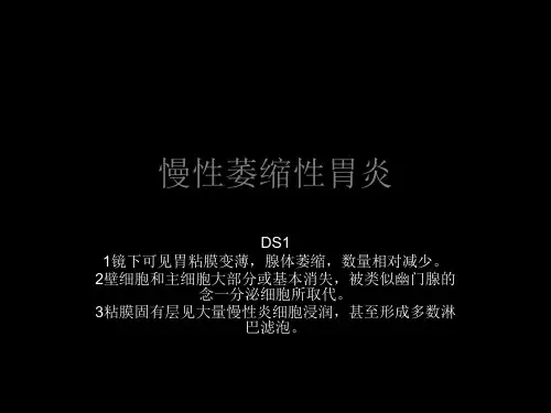 慢性萎缩性胃炎ppt课件 共48页