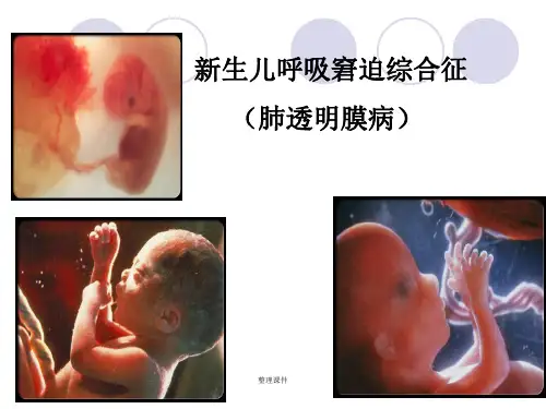 新生儿肺透明膜病