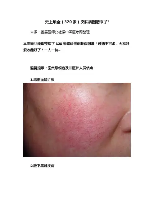 史上最全（320张）皮肤病图谱来了!
