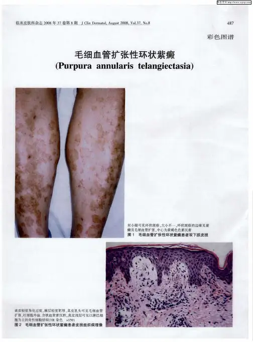 毛细血管扩张性环状紫癜