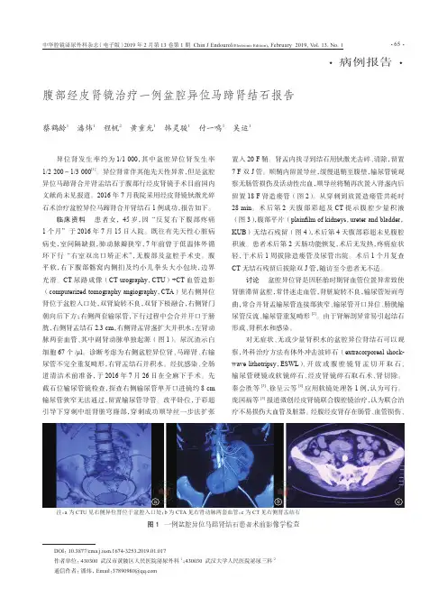 腹部经皮肾镜治疗一例盆腔异位马蹄肾结石报告