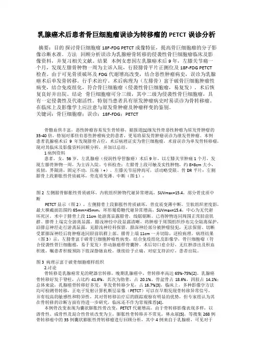 乳腺癌术后患者骨巨细胞瘤误诊为转移瘤的PETCT误诊分析