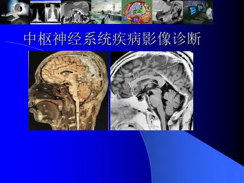 中枢神经系统疾病影像诊断