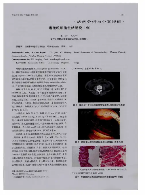 嗜酸粒细胞性结肠炎1例