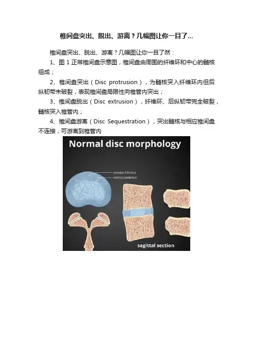 椎间盘突出、脱出、游离？几幅图让你一目了...