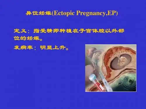 异位妊娠(Ectopic Pregnancy,EP