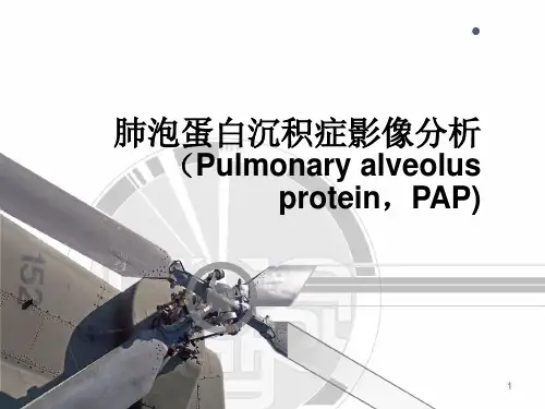 肺泡蛋白沉积症ppt参考课件