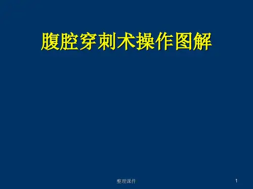 腹腔穿刺术操作图解
