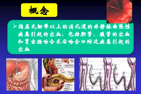 急性非静脉曲张性上消化道出血诊治指南