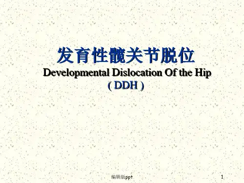 发育性髋关节脱位医学PPT