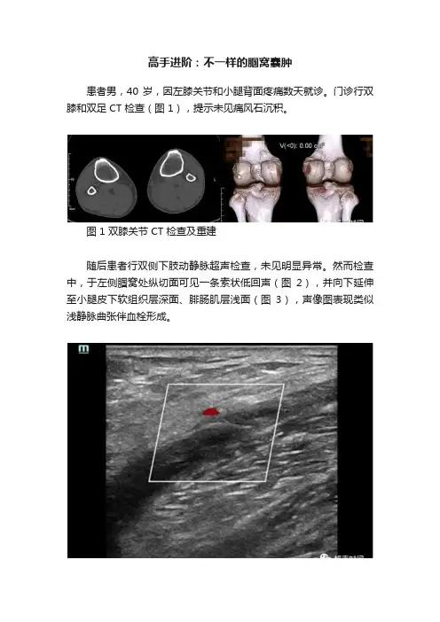 高手进阶：不一样的腘窝囊肿