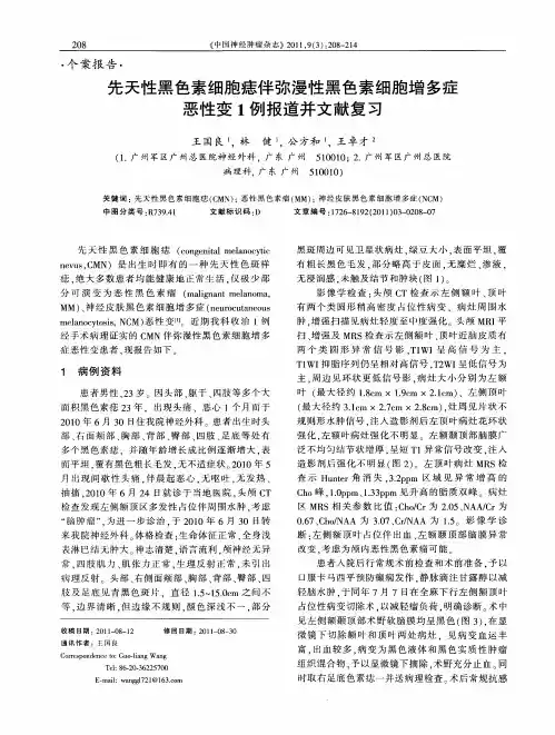 先天性黑色素细胞痣伴弥漫性黑色素细胞增多症恶性变1例报道并文献复习