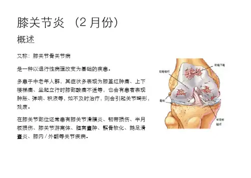 健康宣教_膝关节炎