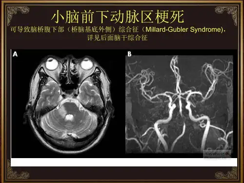 脑血管解剖及脑梗塞定位诊断-迷路动脉