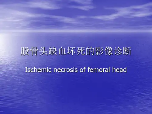 股骨头缺血坏死的影像诊断.ppt