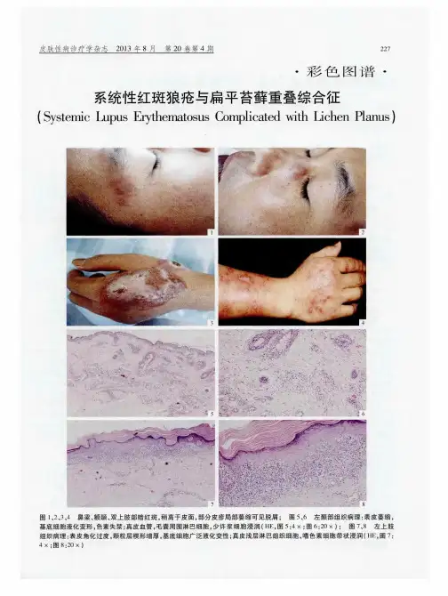 系统性红斑狼疮与扁平苔藓重叠综合征