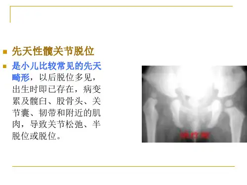 先天性髋关节脱位