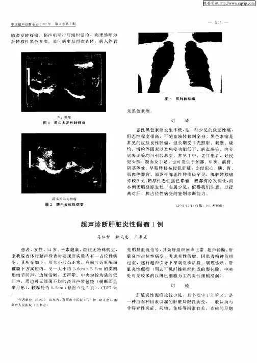 超声诊断肝脏炎性假瘤1例