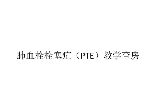 肺栓塞教学查房