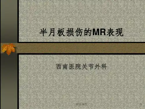 半月板损伤的MRI表现ppt课件
