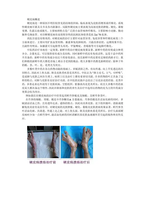 为什么新鲜中药能够治疗硬皮病